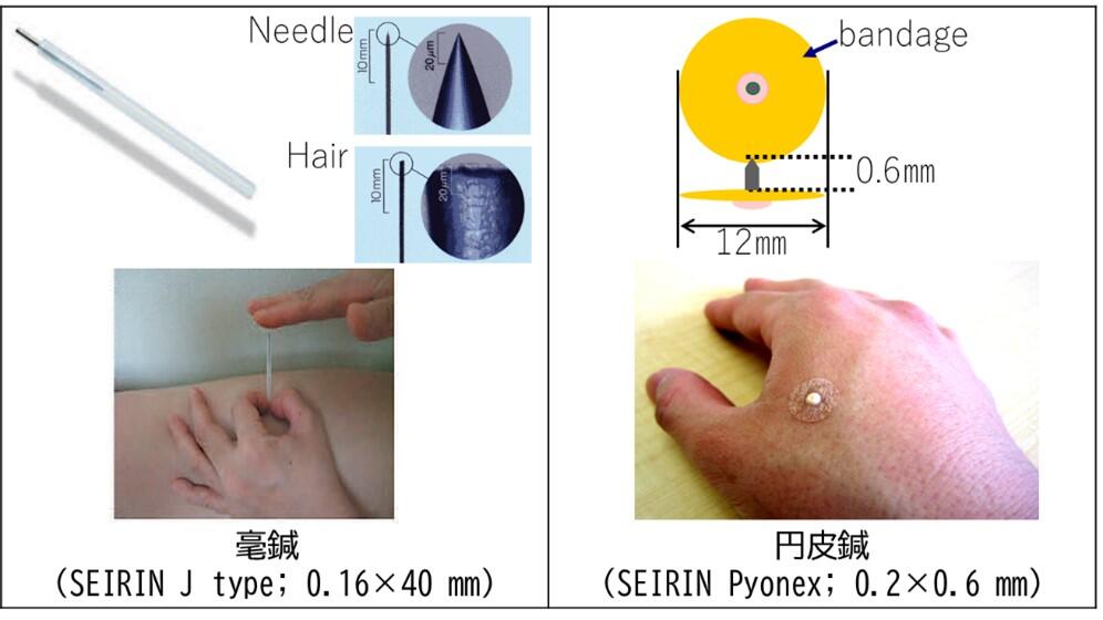 図１　施術で利用した鍼（毫鍼と円皮鍼）